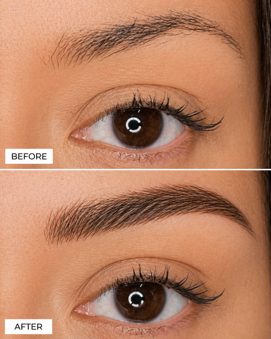 Before & After — FUE Transplant