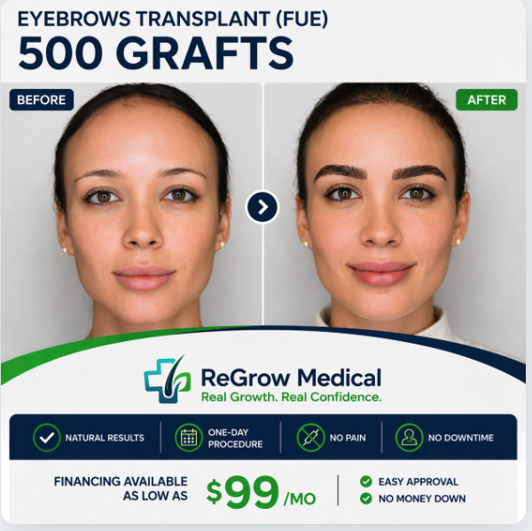 500 Grafts Eyebrow Transplant Before and After